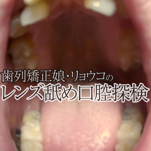 歯列矯正中のリョウコの口腔内に防水カメラ潜入させ本当のレンズ舐め