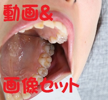 虫歯の本数にがっくし千秋　★★動画＆画像セット★★元歯科助手ｗｗ　