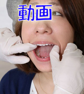 由香ちゃんの白い歯　意識は高いけど治療痕が　動画