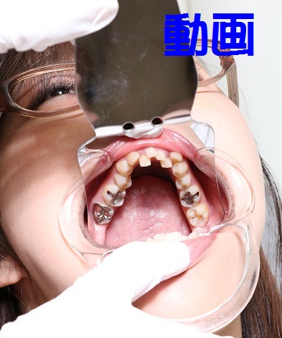 弥生ちゃんは元歯科助手なのに立派な銀歯が何本も　動画