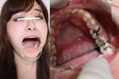 銀歯・脱離・放置のコンボ　奈緒ちゃんの歯