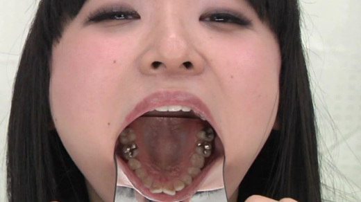 歯フェチ動画　口内にインレーがいっぱいの咲希ちゃん