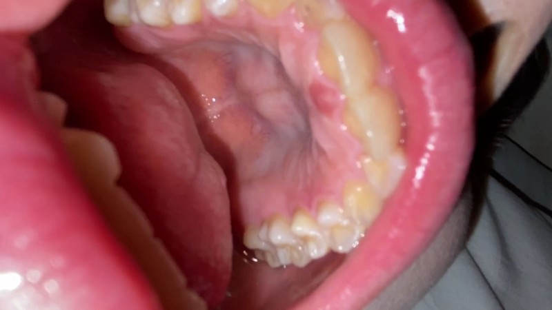 治療痕が極端に少ない美歯列but醜歯色 ユウ② KITR00278