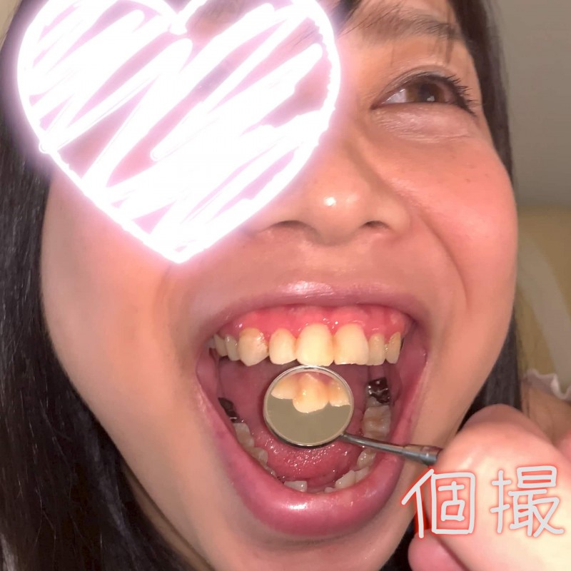 【個人撮影】『※デブ専』樽娘の銀歯多めな歯強度チェック　こころ【Y-158】