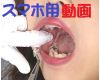 Teeth of YAYOI　capped in silver　Movie