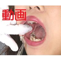 Teeth of YAYOIcapped in silverMovie