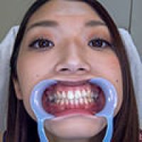 【歯フェチ】香苗レノンちゃんの歯を観察しました！