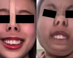 Gcolle PPV 841038 プレミア★ノーズＸＸ　100人に1人のﾊﾟﾝｽﾄ顔美女